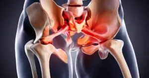 Total Hip Replacement surgery in Chennai